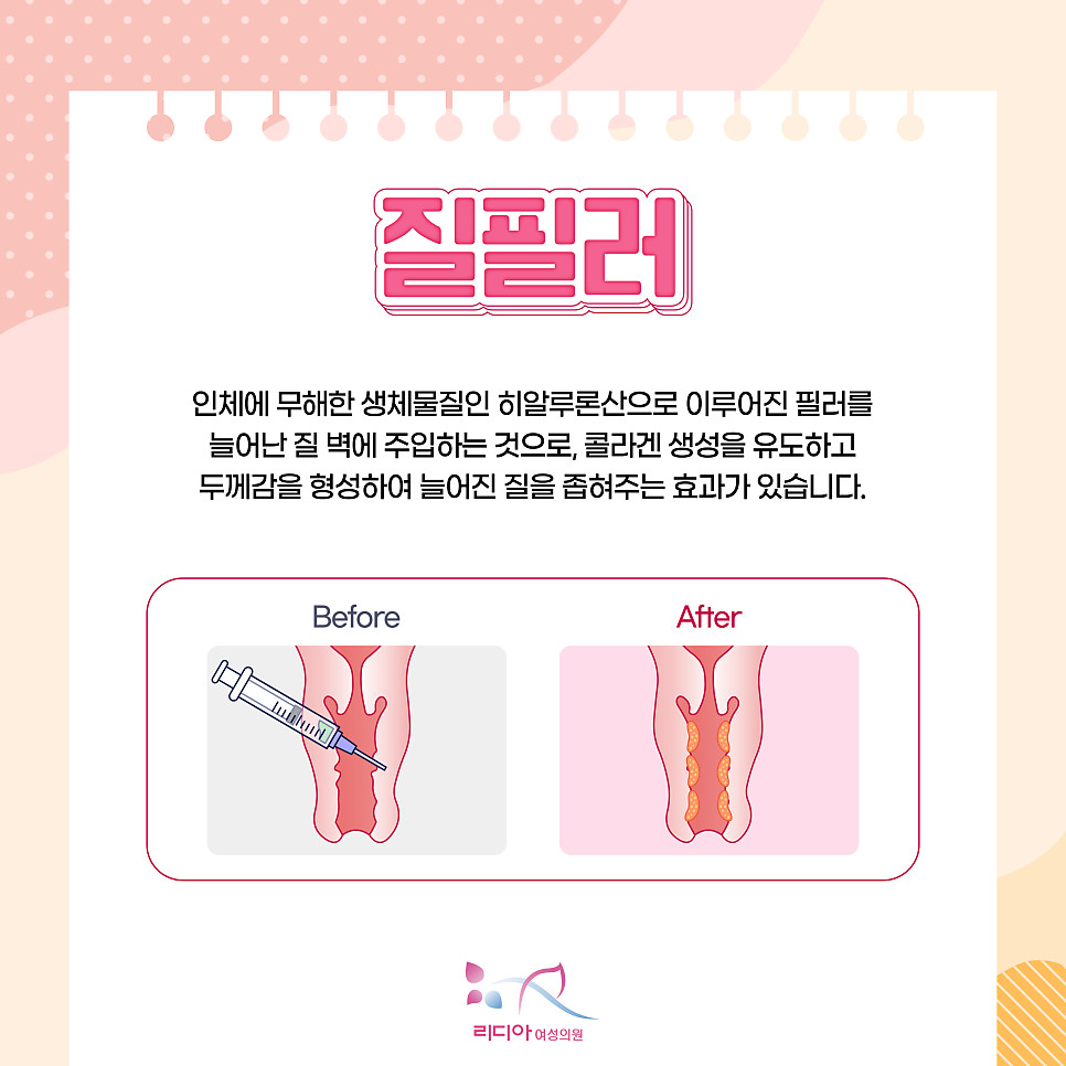 강남질타이트닝 질필러기간 확인 전 여성 질 건강과 자궁 연결 역할 기본 관리