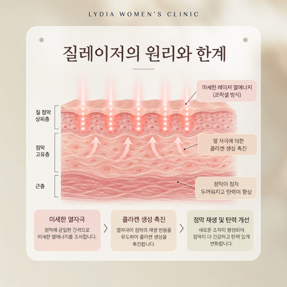 질레이저가 점막 재생을 유도하는 원리와 원인 치료가 먼저인 한계